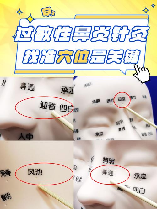 针灸扎人中有什么作用