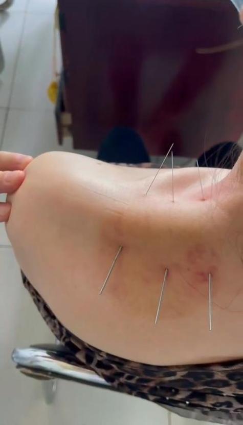 肩周炎扎针灸多久能好