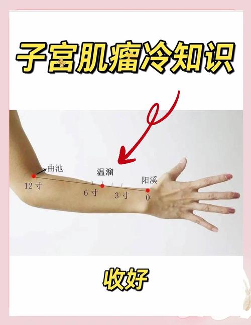 子宫肌瘤针灸哪些部位