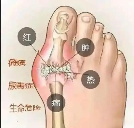 痛风很痛的时候怎么办