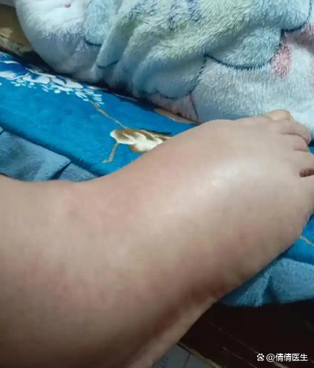 吃了非布斯他痛风更疼