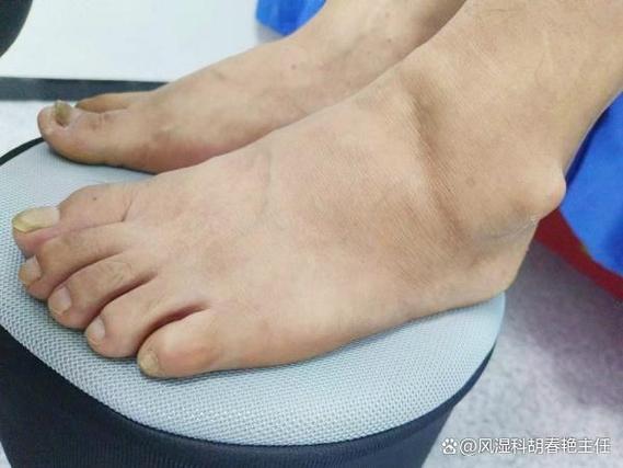 吃了非布斯他痛风更疼