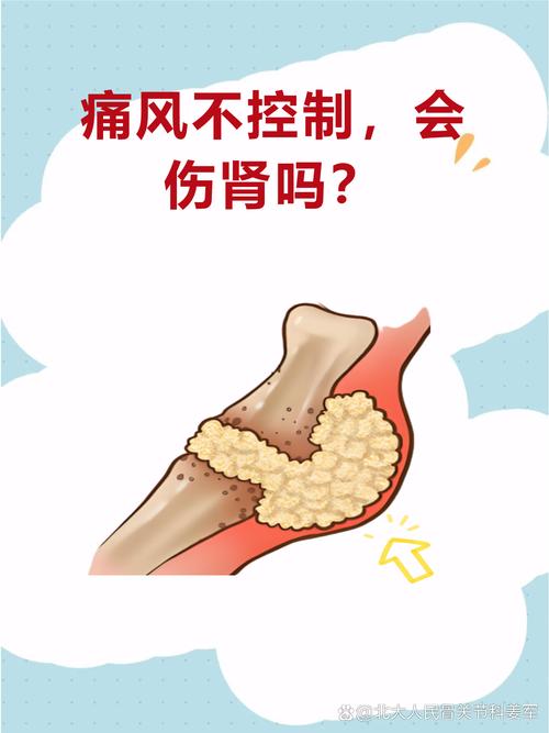 痛风不吃药硬挺对肾有