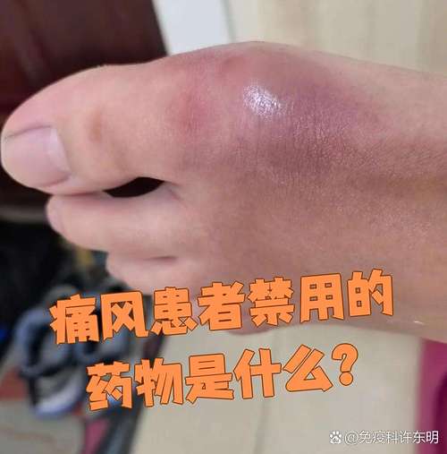 痛风不吃药硬挺对肾有