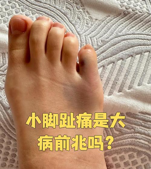 小脚趾痛可能是痛风吗