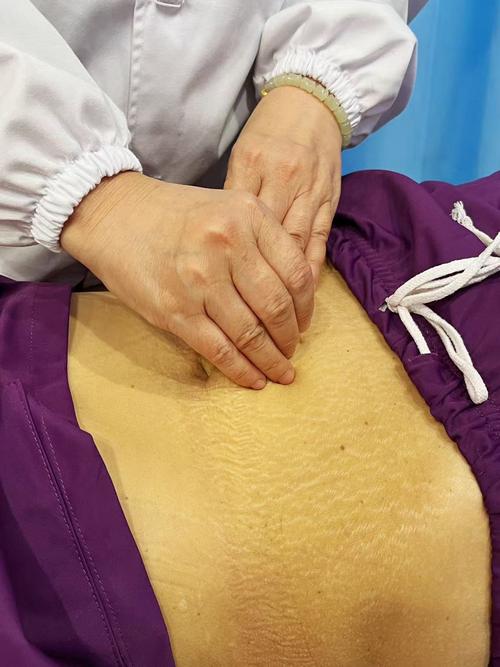 贴针灸丰胸真的有效吗