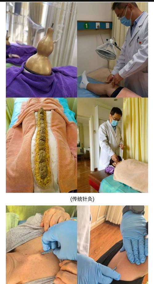 针灸治疗强直性脊椎炎