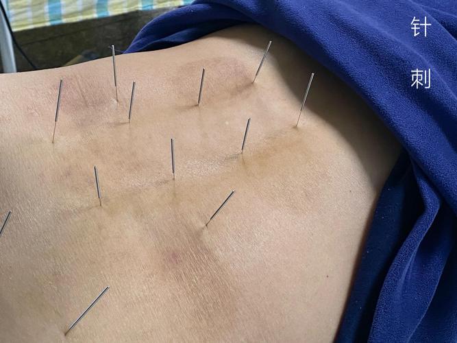 针灸治疗强直性脊椎炎