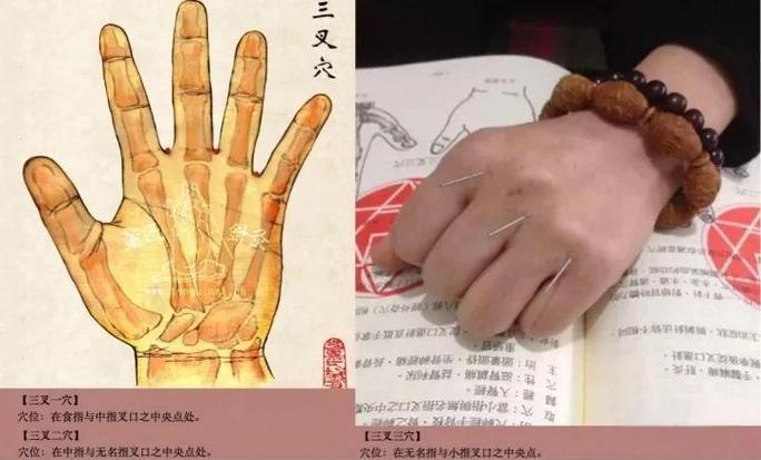 董氏针灸72绝针视频