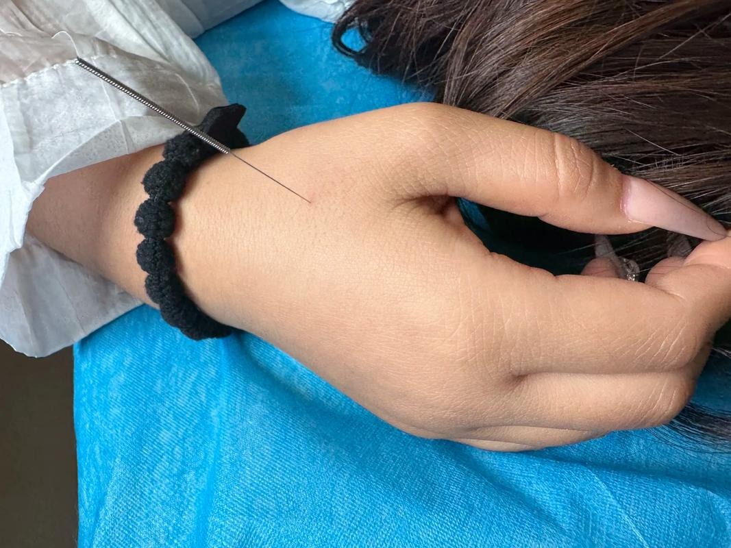 梦见身上扎了很多针灸