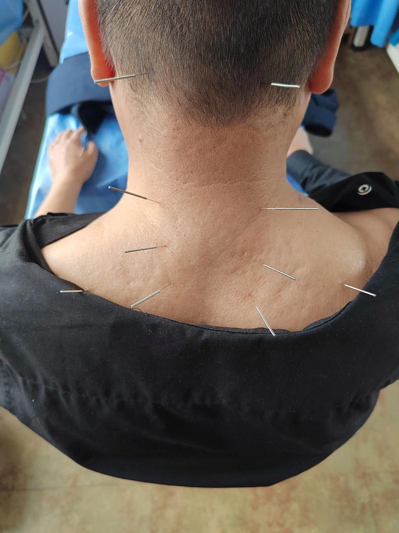 梦见身上扎了很多针灸