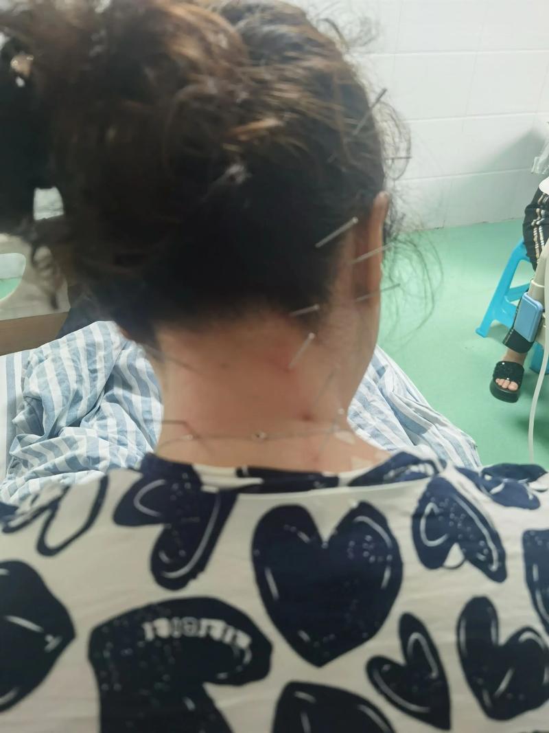 针刀和针灸哪个效果好