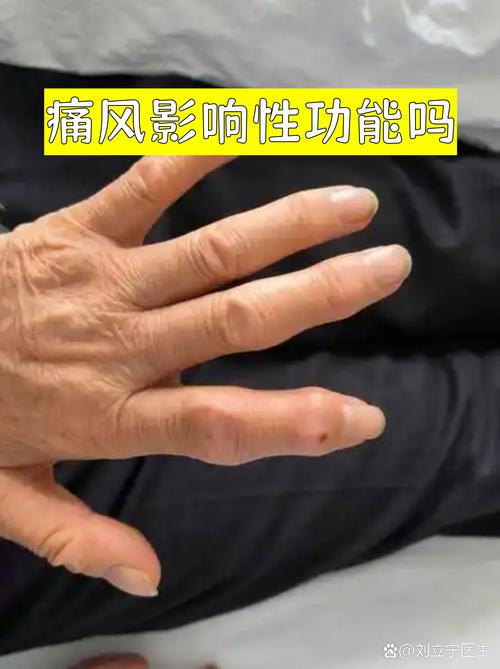 痛风跟性生活有关系吗