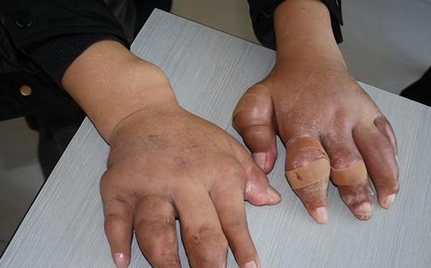 豇豆痛风病人可以吃吗