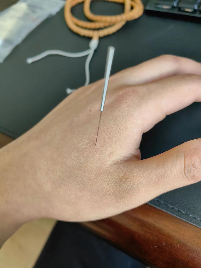 手腕扭伤针灸哪个部位