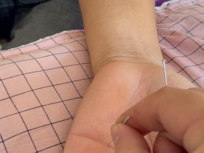 手腕扭伤针灸哪个部位