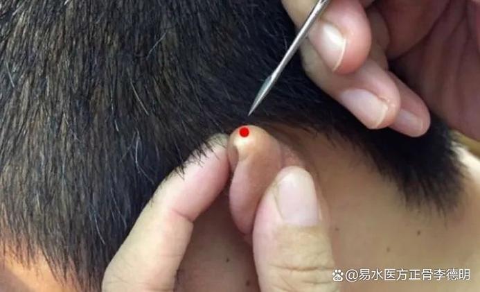 针灸能治脑供血不足吗