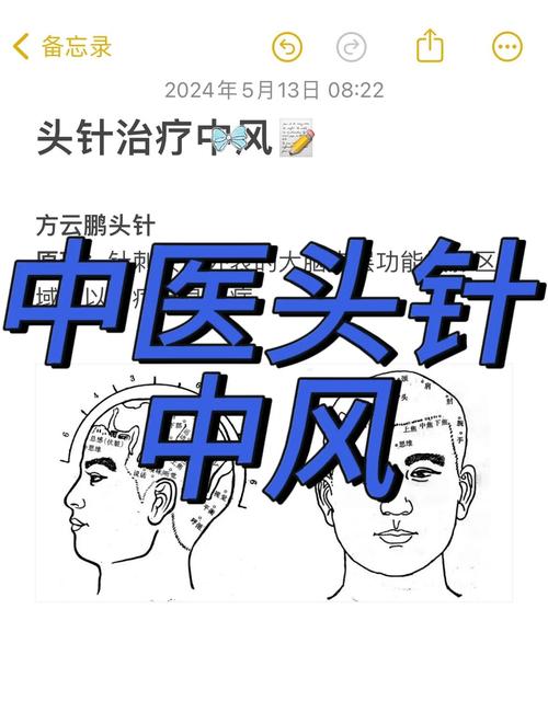 针灸能治脑供血不足吗