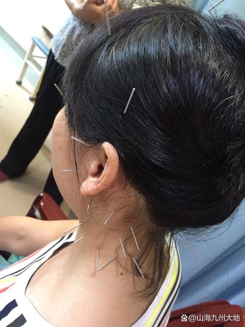 颈椎病可以针灸治疗吗