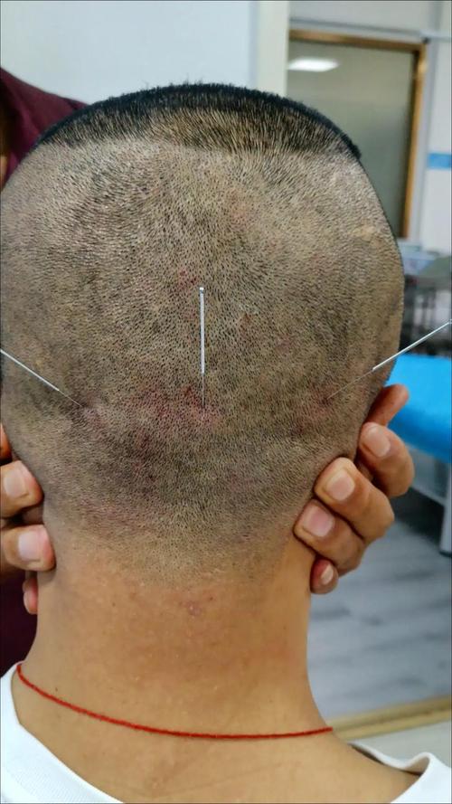 头部针灸后可以洗头吗