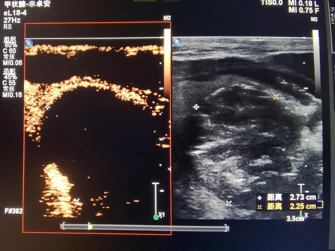 针灸能治甲状腺结节吗