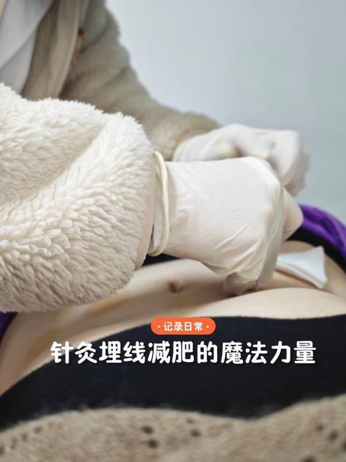 针灸埋线减肥多久见效