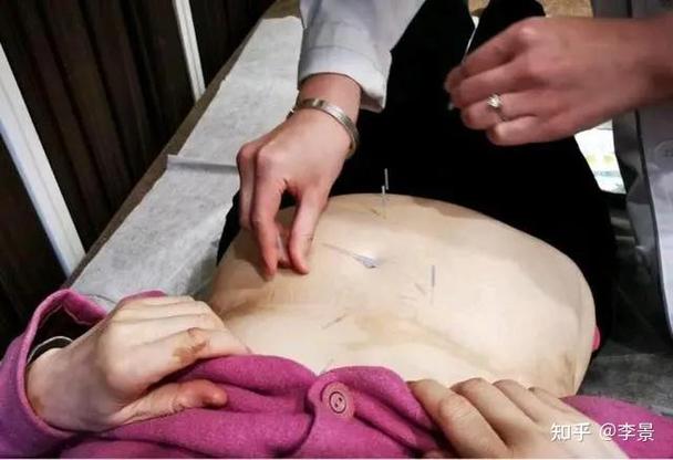 腰椎间盘突出针灸取穴