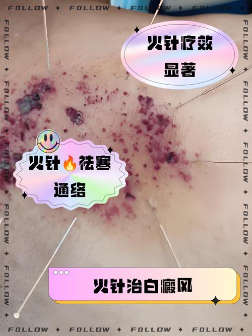 针灸火针的功效与作用