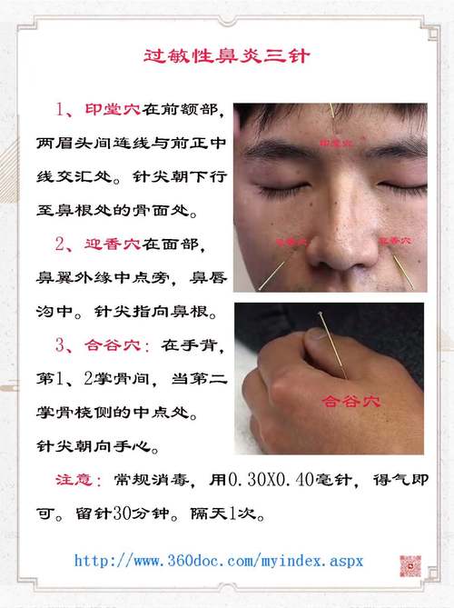 针灸能治过敏性鼻炎吗