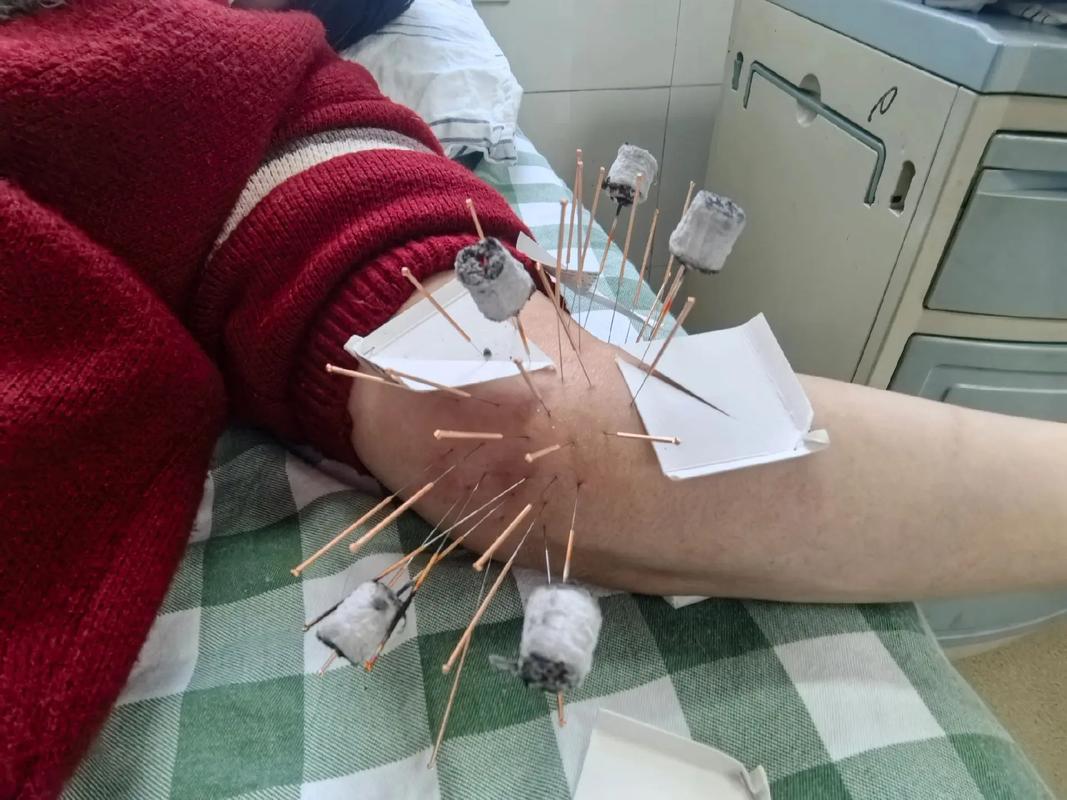 针灸治疗类风湿关节炎