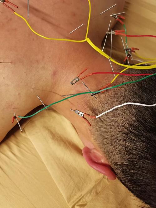 颈椎病头晕可以针灸吗