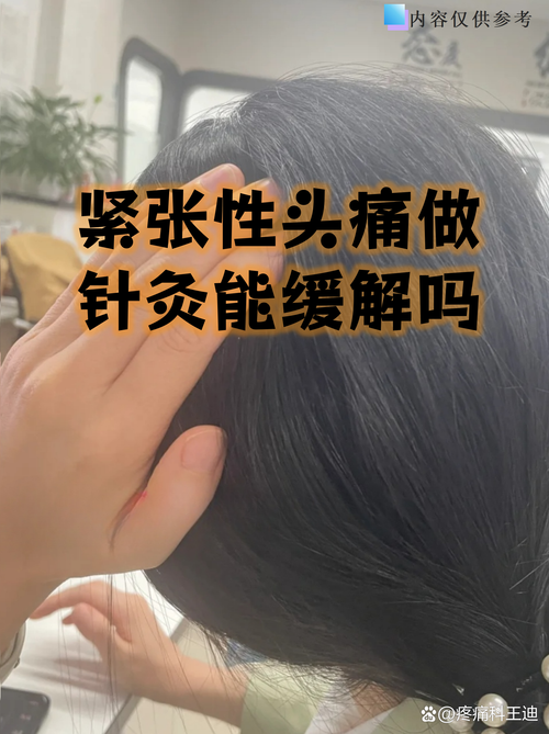 神经性头疼可以针灸吗