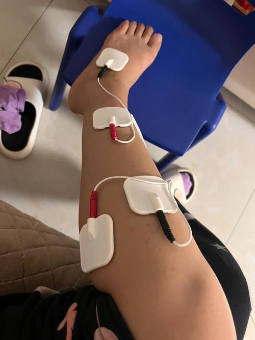 腓总神经损伤针灸治疗