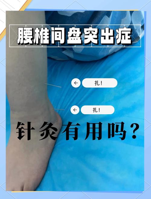 腰椎间盘突出针灸疼吗