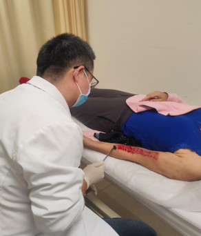 带状疱疹针灸治疗方法