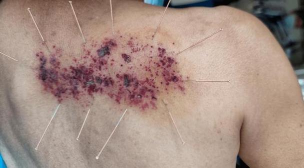 带状疱疹针灸治疗方法