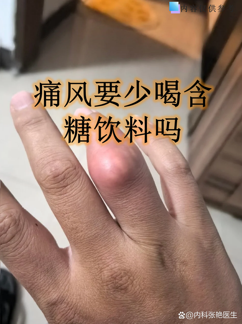 痛风有被攻克的可能吗