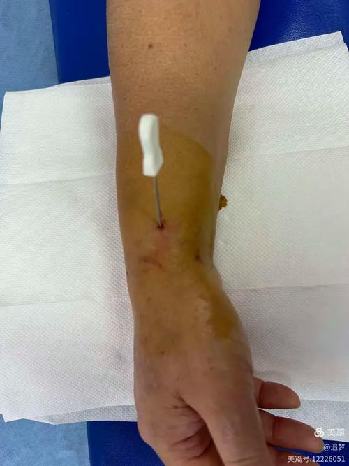 手腕腱鞘炎针灸有用吗