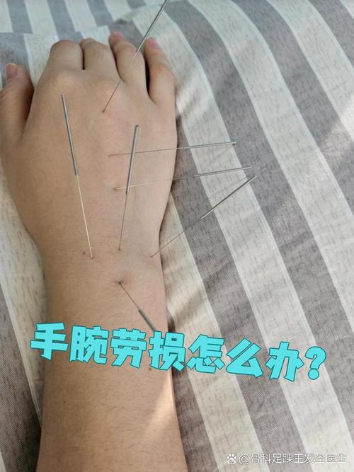 手腕腱鞘炎针灸有用吗
