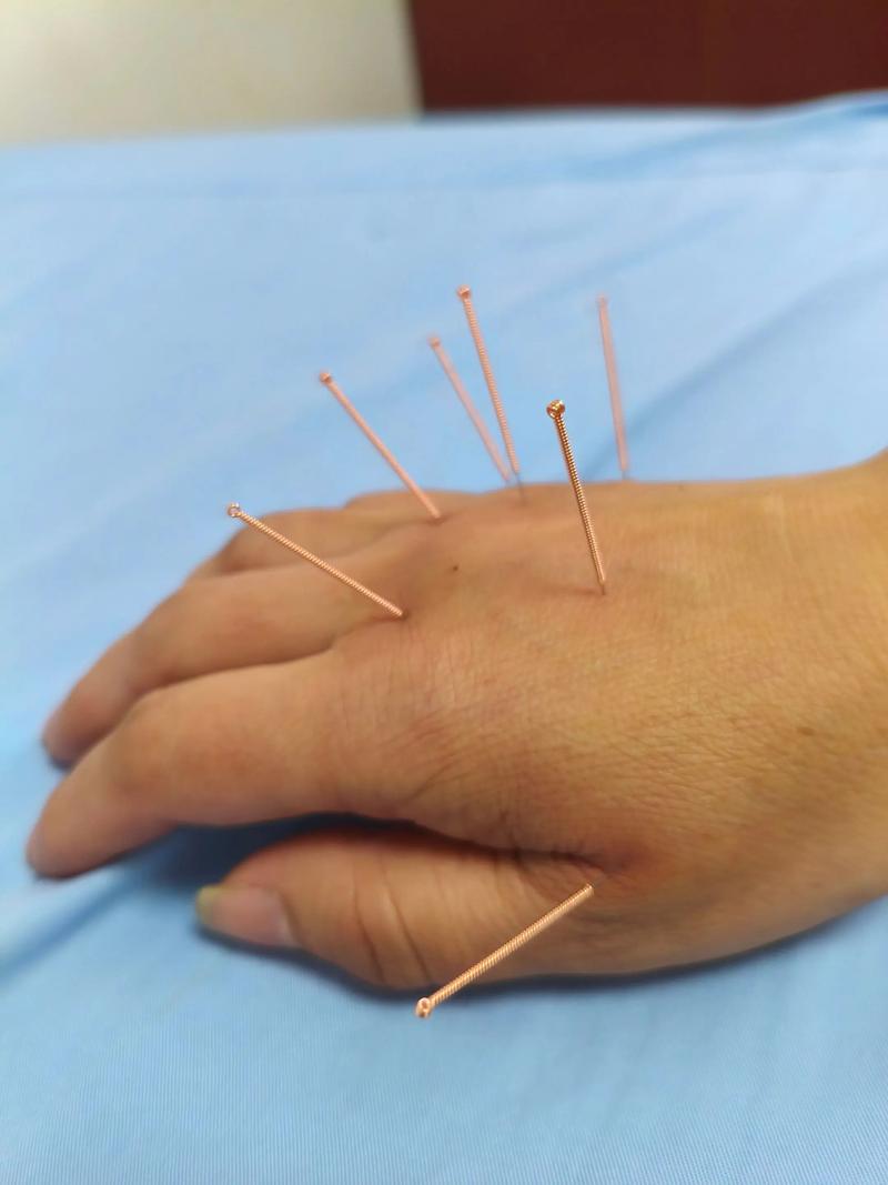 手腕腱鞘炎针灸有用吗