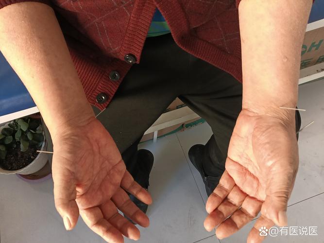 针灸可以治疗抑郁症吗