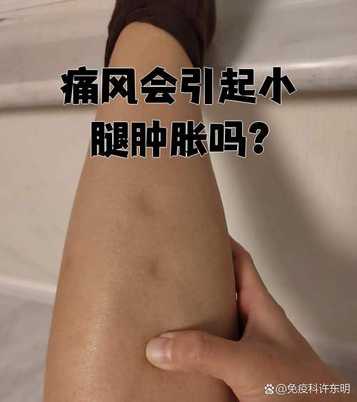 痛风会引起小腿酸痛吗