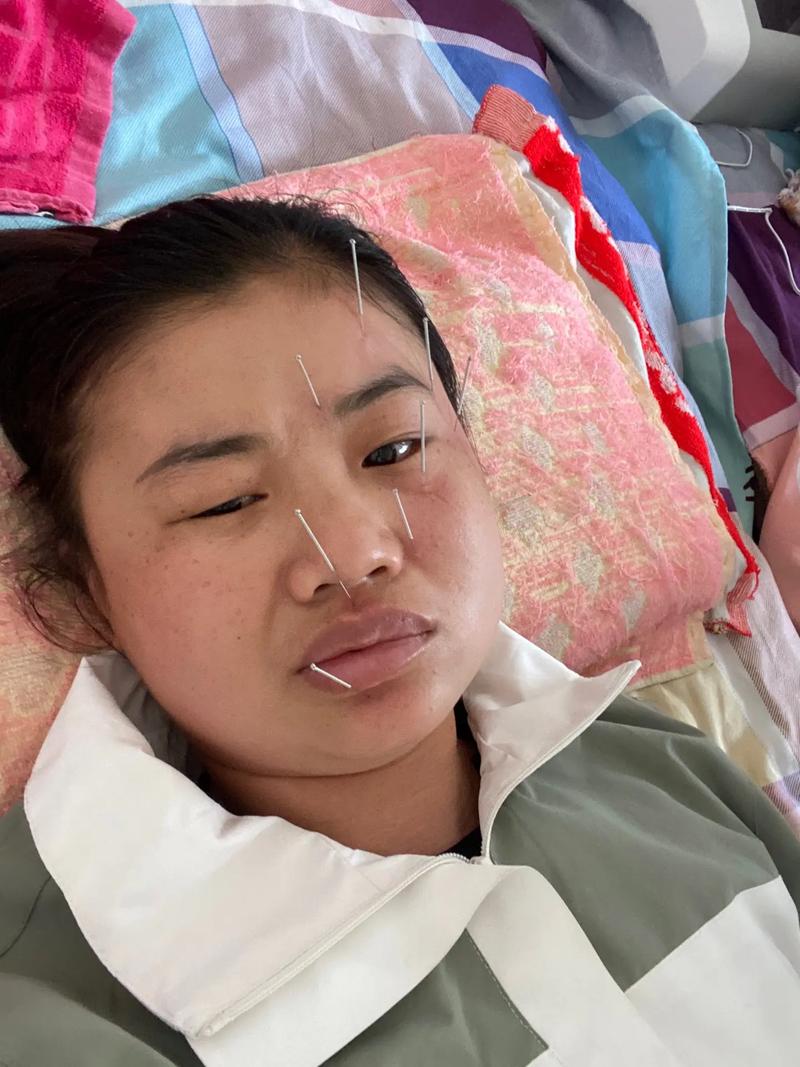 面瘫针灸会有后遗症吗