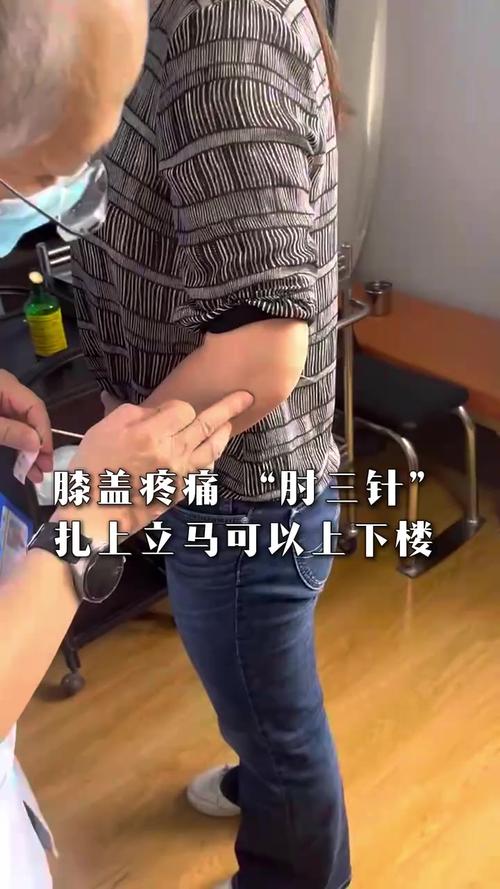 网球肘可以针灸治疗吗