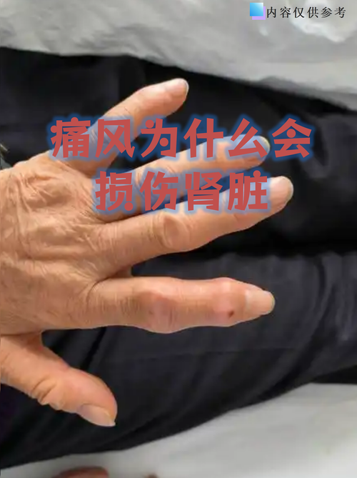 痛风根源是肾功能差吗