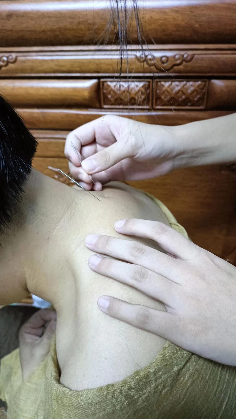 针灸可以消除富贵包吗