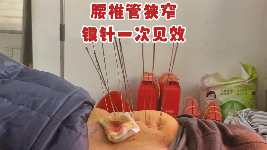 腰椎间盘突出针灸视频