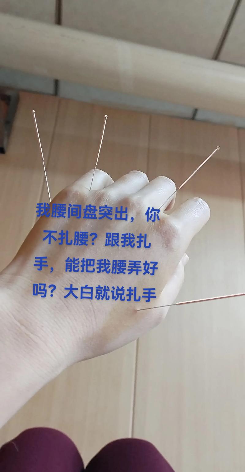 腰椎间盘突出能针灸吗