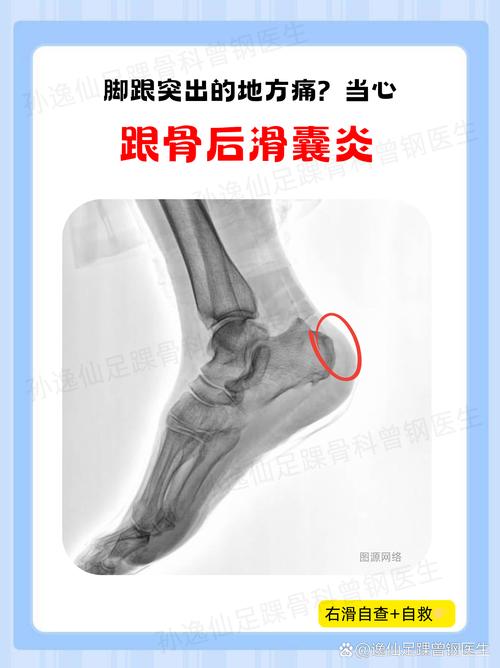 脚后跟痛是痛风的症状