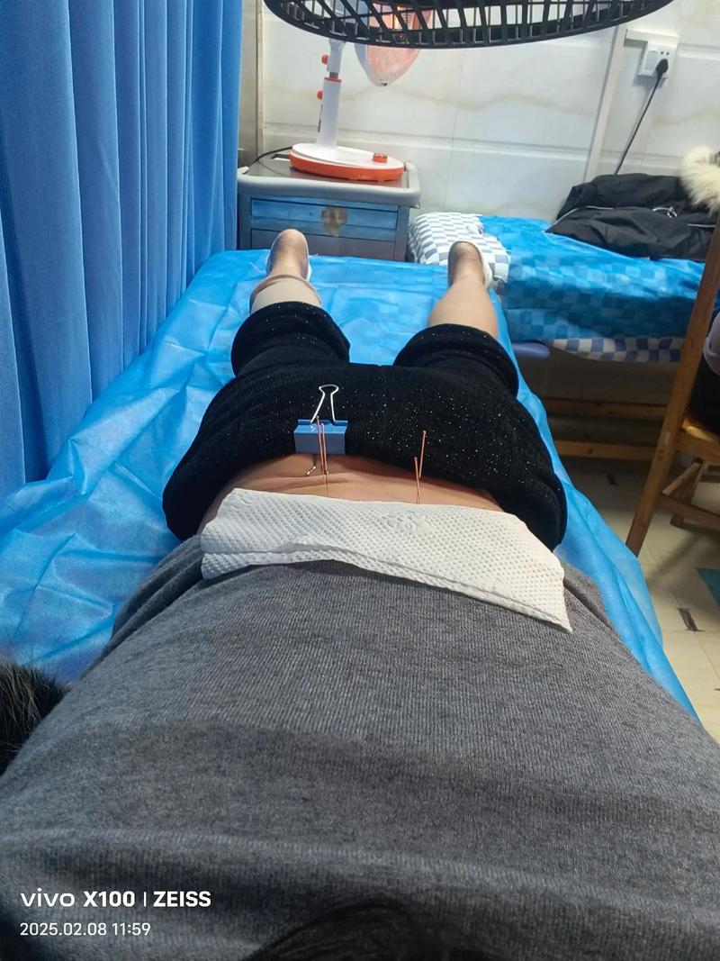 椎间盘突出针灸有用吗